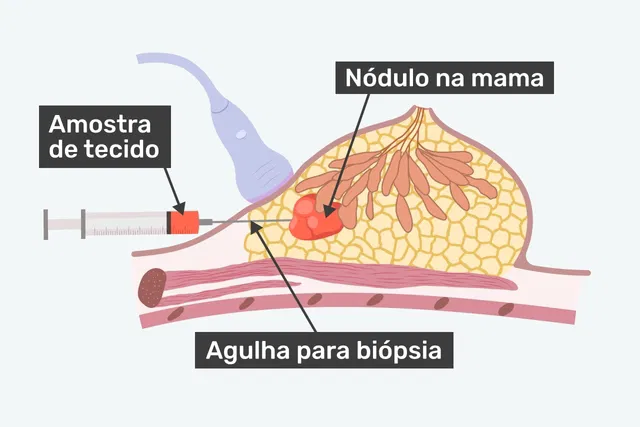 biópsia de mama