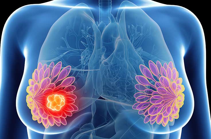 imagem ilustrando cancer de mama