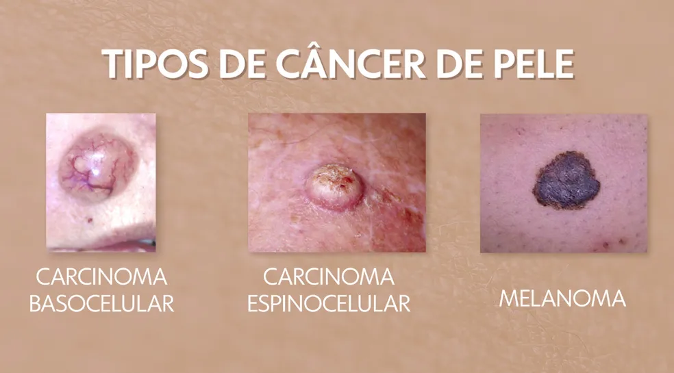 Imagens de lesões de câncer de pele: carcinoma basocelular, espinocelular e melanoma. Reconheça os sinais.