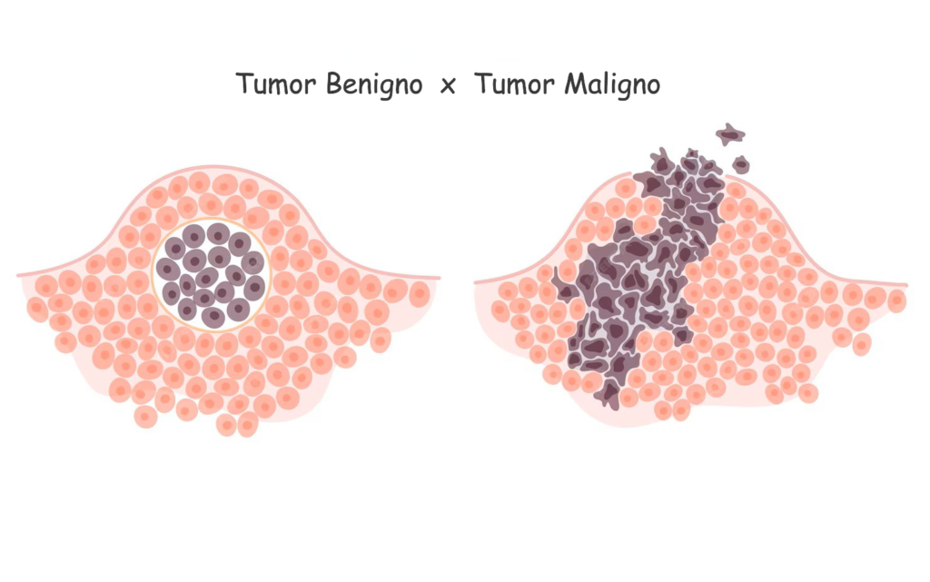 diferença entre tumor benigno e tumor maligno