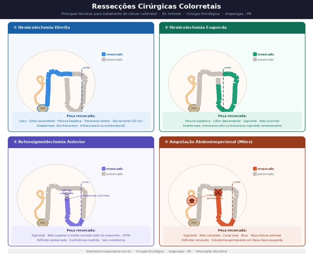 Ressecções cirúrgicas no câncer colorretal: hemicolectomia direita e esquerda, retossigmoidectomia anterior e amputação abdominoperineal de reto