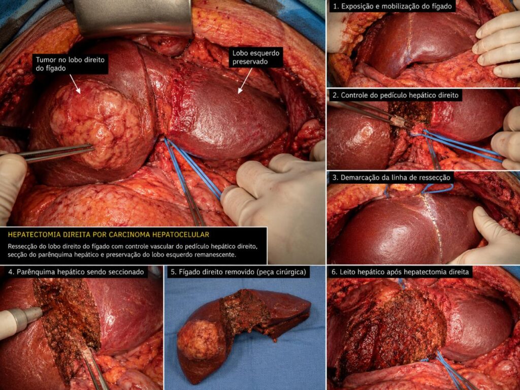 Hepatectomia para tumor hepático - Dr Antonio Carlos Tourinho de Castro - especialista em Cirurgia Oncológica