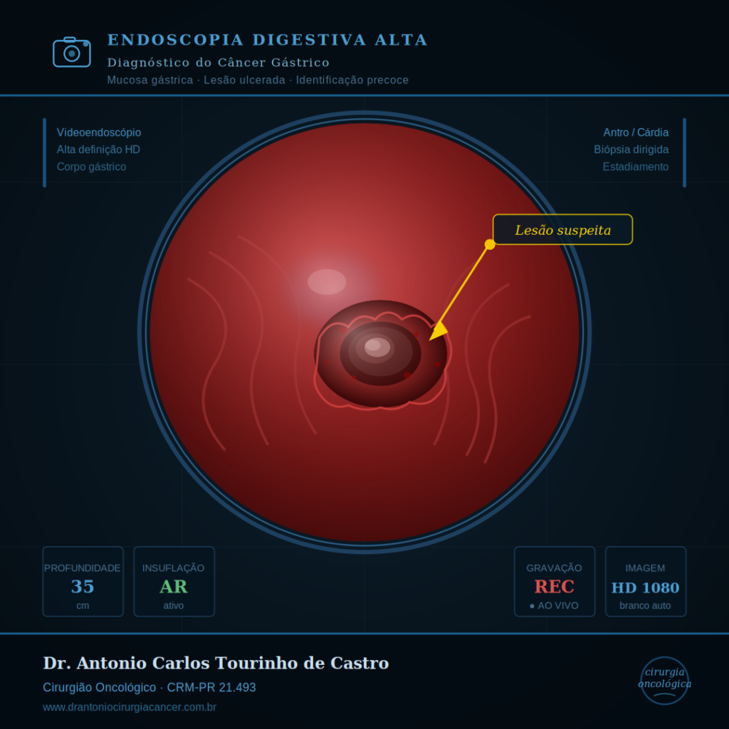 Endoscopia digestiva alta mostrando mucosa gástrica com lesão ulcerada suspeita de câncer gástrico — Dr. Antonio Carlos Tourinho de Castro, Cirurgião Oncológico, Arapongas-PR